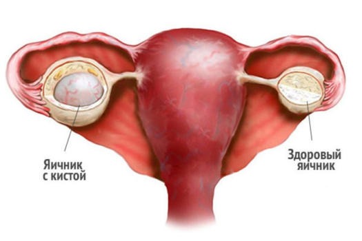 паркинсон