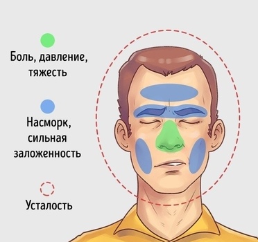 гайморит симптомы