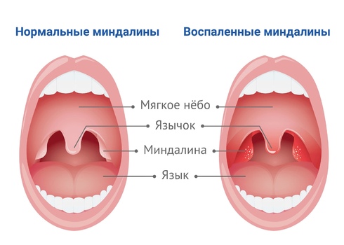 нормальные и воспаленные миндалины